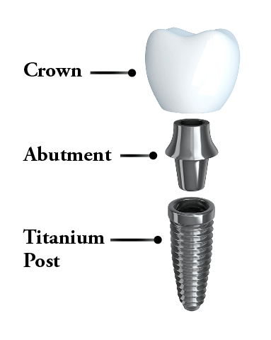 The three parts of a dental implant. Screw, Abutment, and Crown