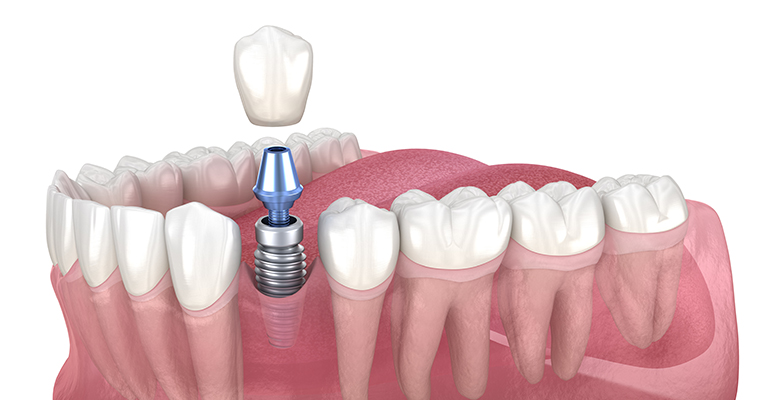 A close-up of a model showing the placement of a dental implant.